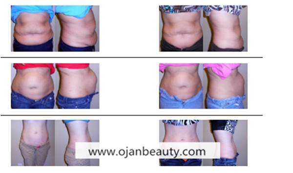 result of lipo laser.jpg