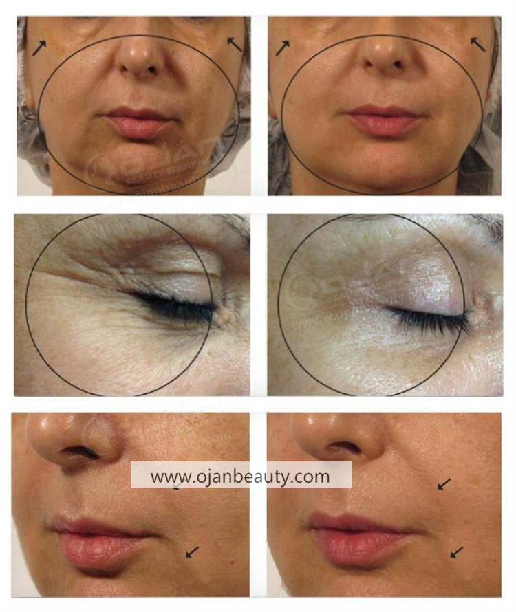 2021 New 3 in 1 Super Facial Oxygeneo Exfoliation Therapy machine 