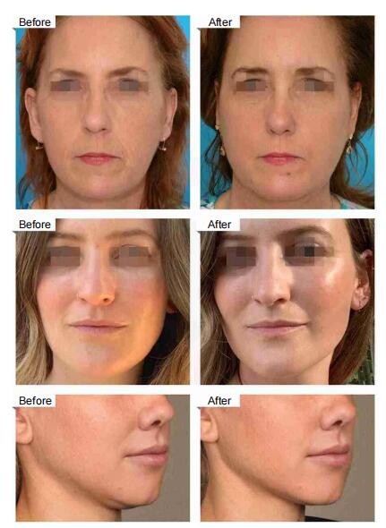 emrf muscle stimulation face